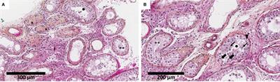 Case Report: Longitudinal follow-up and testicular sperm extraction in a patient with a pathogenic NR5A1 (SF-1) frameshift variant: p.(Phe70Serfs*5)